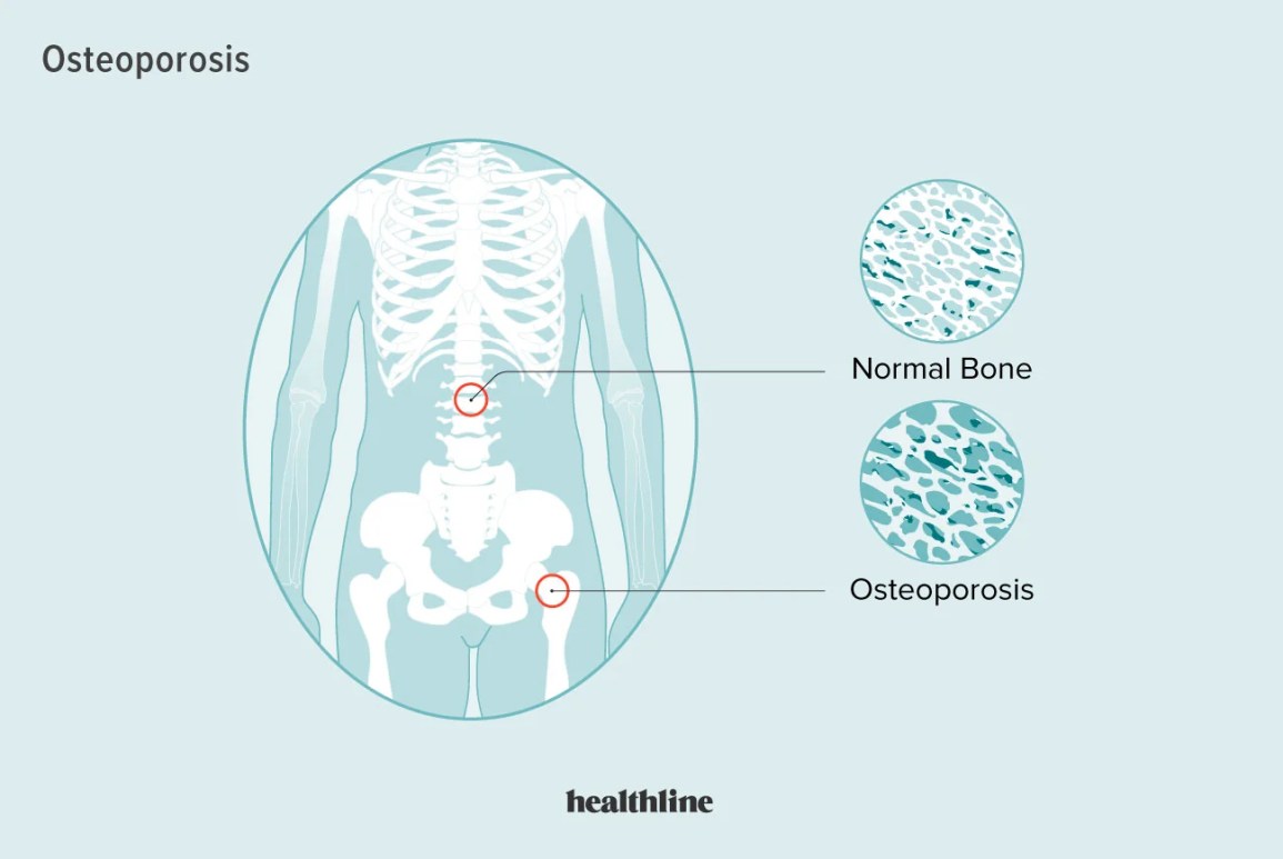Does osteoporosis cause pain if there are no fractures?