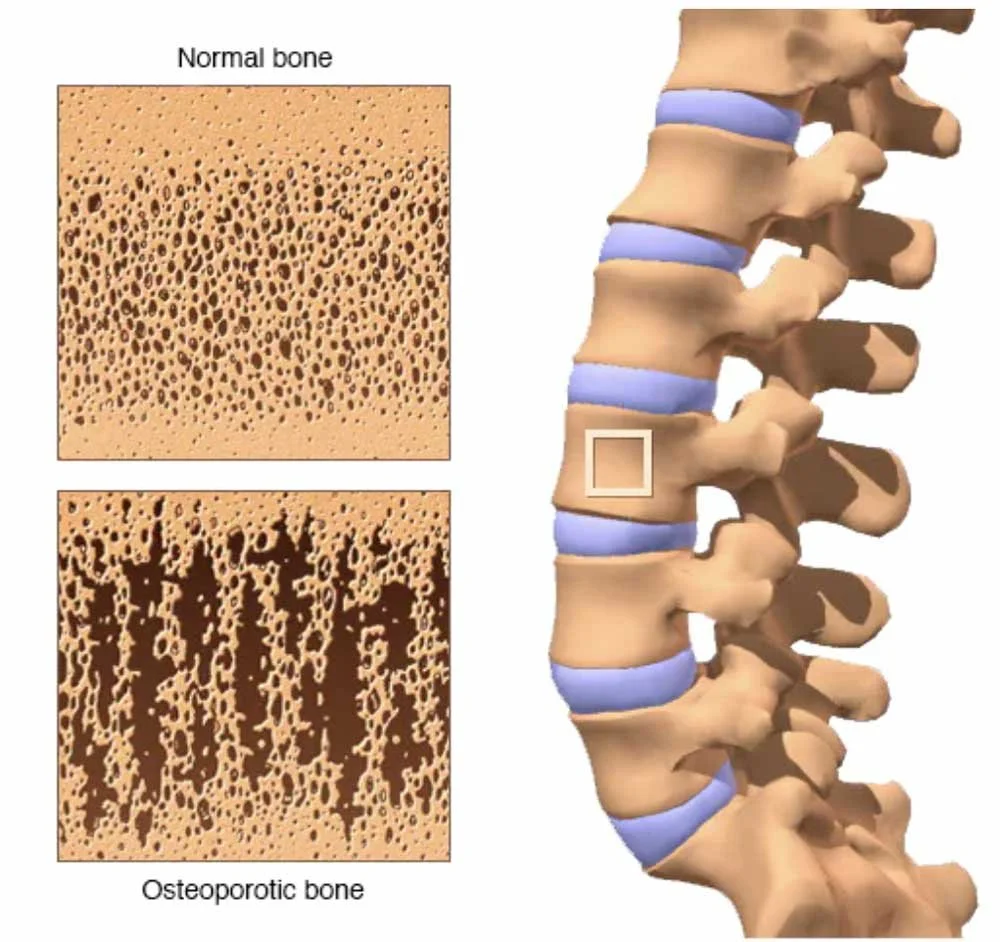 Does Walking Increase Bone Density in Spine and How?