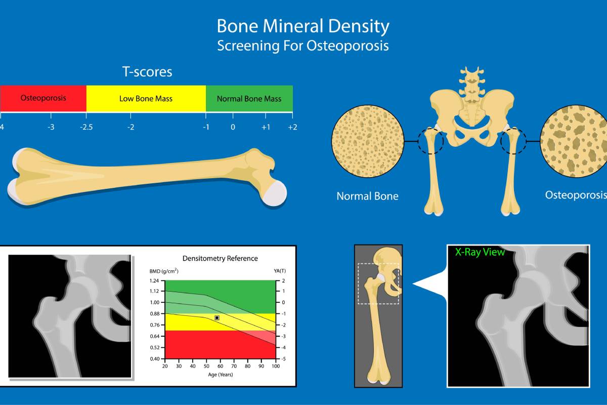 Female Bone Density Chart by Age (T‑Score) Guide