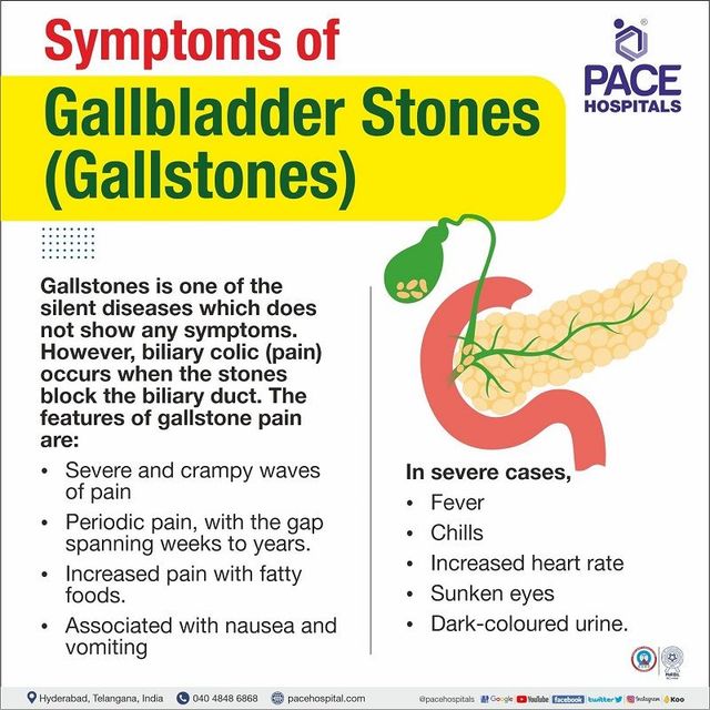 Gallstones Symptoms Female: Spot the Signs and Act Fast