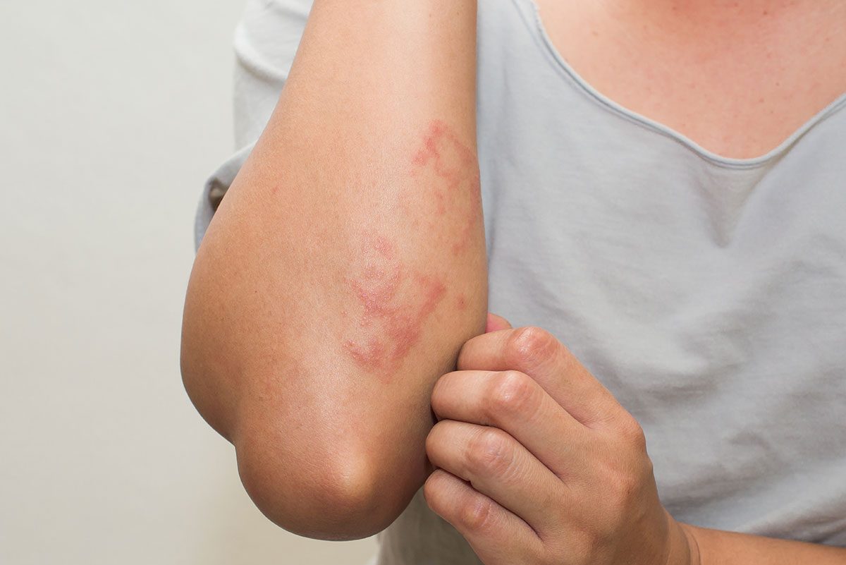 Gluten Allergy Rash Pictures: Spot, Understand & Treat