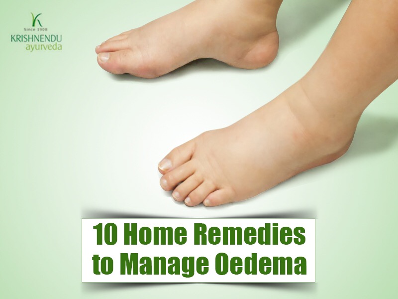 Herbal Remedies for Edema in Legs: Safe Relief
