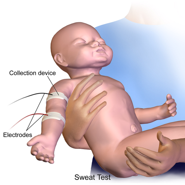How is a Sweat Test Done on an Infant?