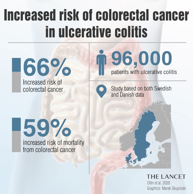 How Long for Ulcerative Colitis to Become Cancer?
