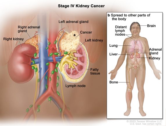 Kidney Cancer Treatment Stage 4: Options & Hope