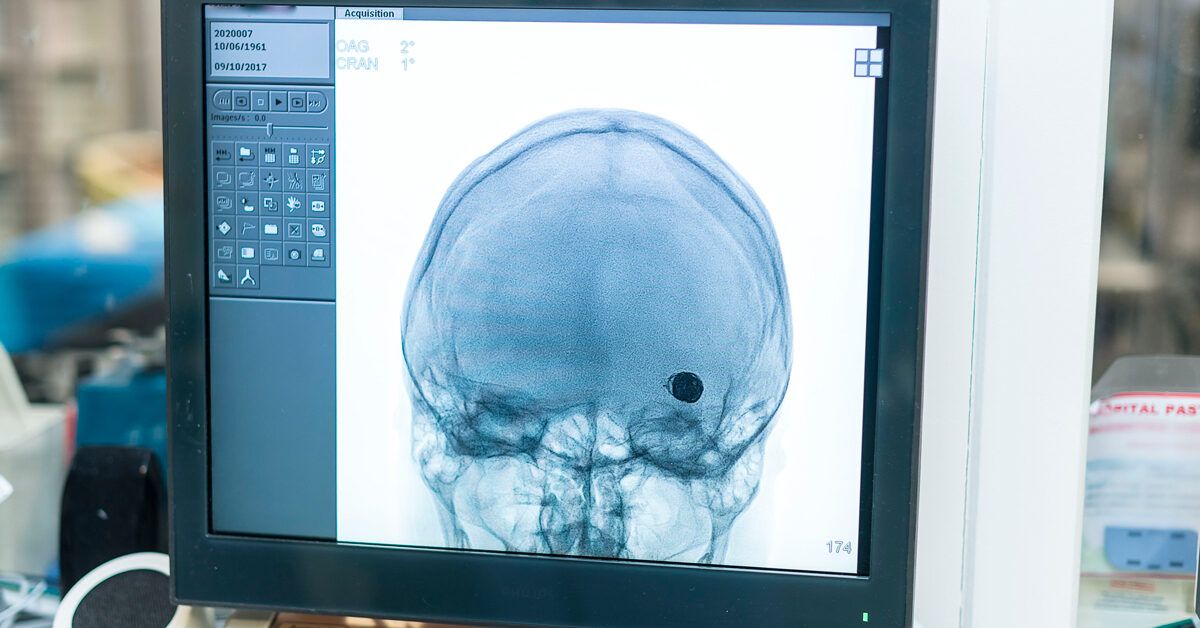 Life After Brain Aneurysm: Expectancy & Outlook