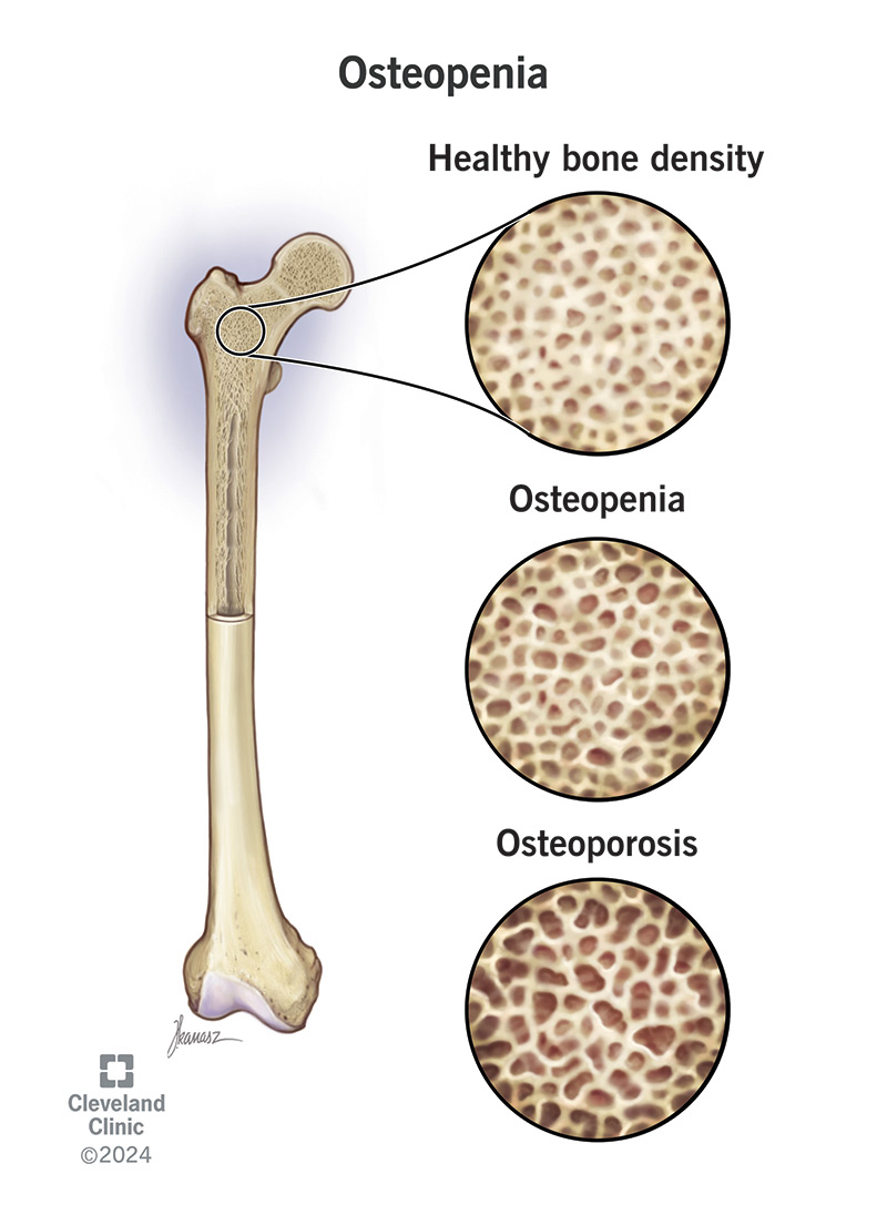 Osteopenia vs Osteoporosis: Risks & Treatment