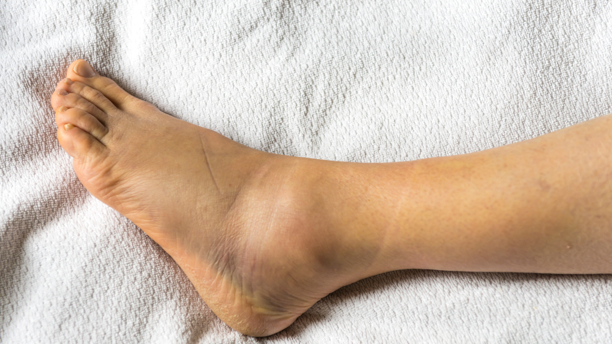 Pictures of Swollen Ankles From Liver Problems