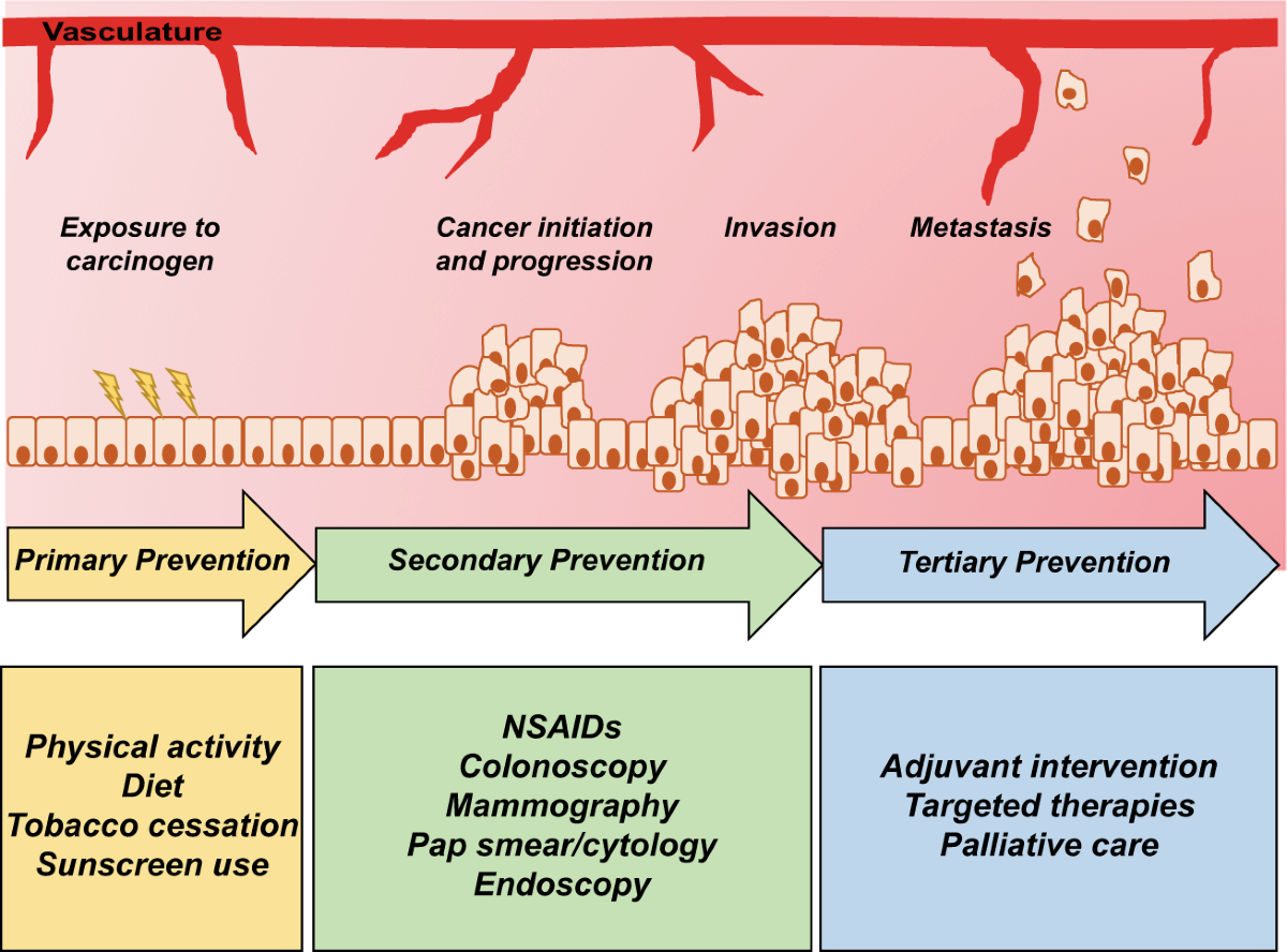 Primary Prevention of Colorectal Cancer: Simple Steps
