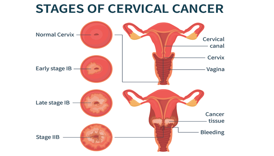 Recurrent Cervical Cancer ICD‑10: Codes & What They Mean