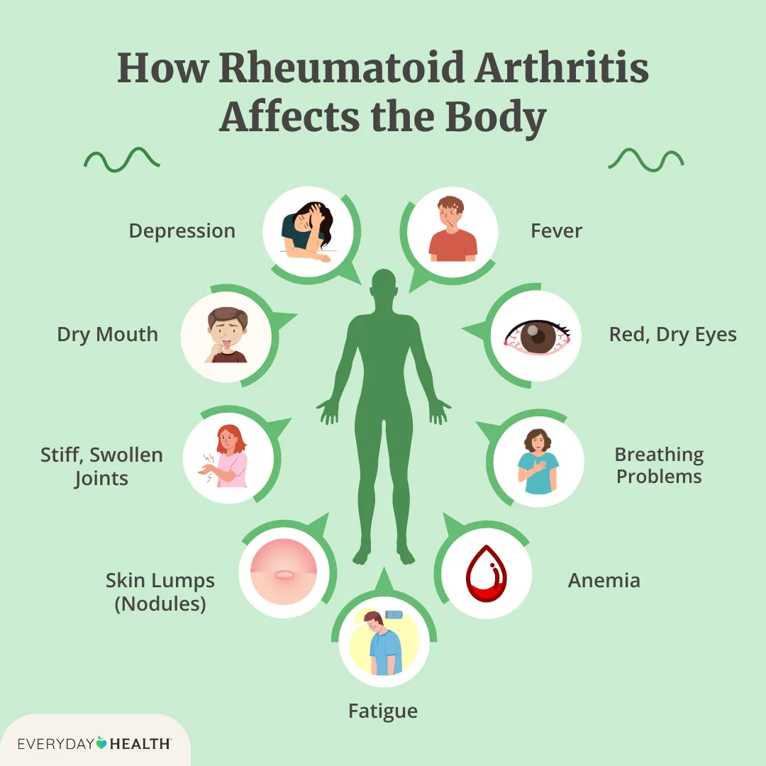 Rheumatoid Arthritis Clinical Presentation Explained