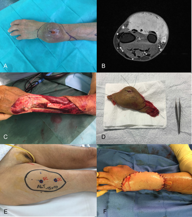Soft Tissue Sarcoma Pictures Arm: Spot the Lump Quickly