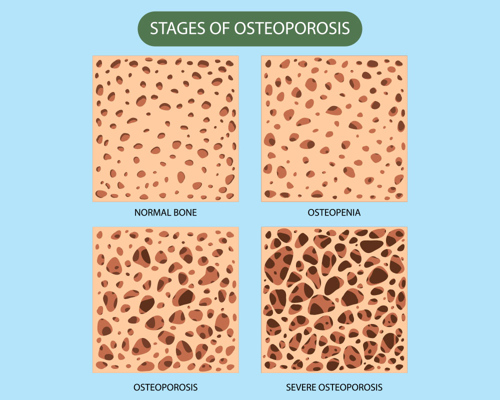 Understanding the Stages of Osteoporosis of the Spine