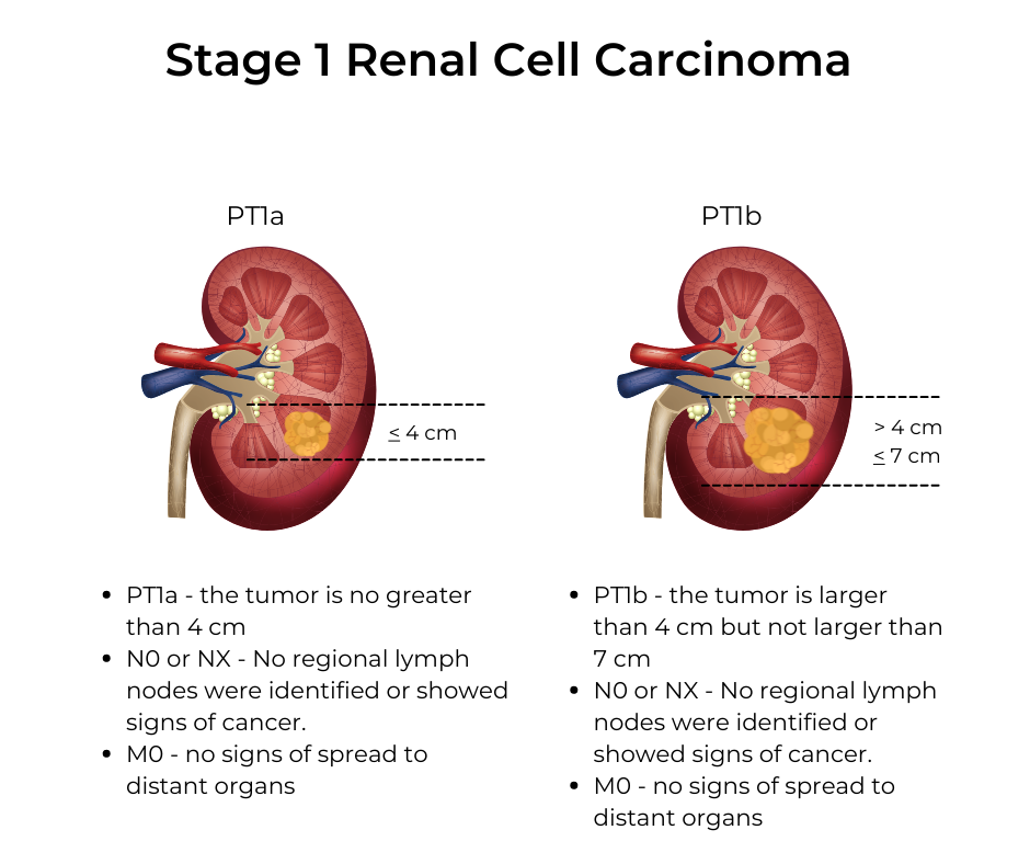 Treatment for Kidney Cancer Stage 1 – Best Options