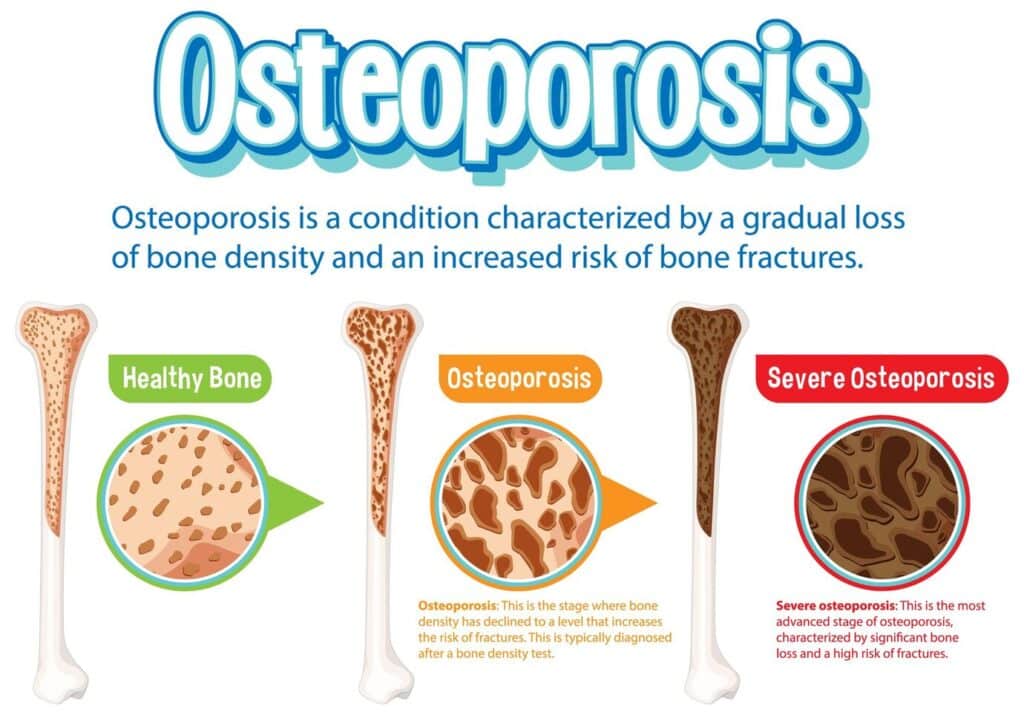 What Are the 5 Stages of Osteoporosis? A Friendly Guide