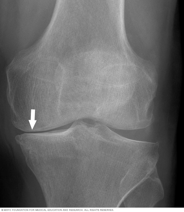 What Does Arthritis Look Like on an X‑Ray Knee?