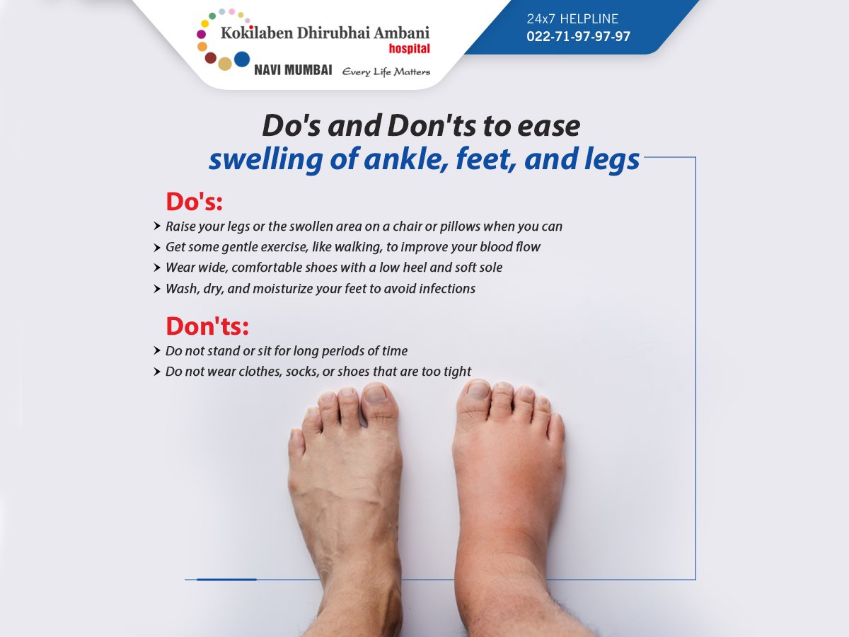 When to go to the hospital for swollen feet & legs?
