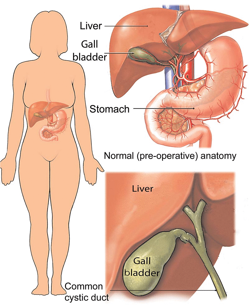 Why Do Females Get Their Gallbladder Removed?