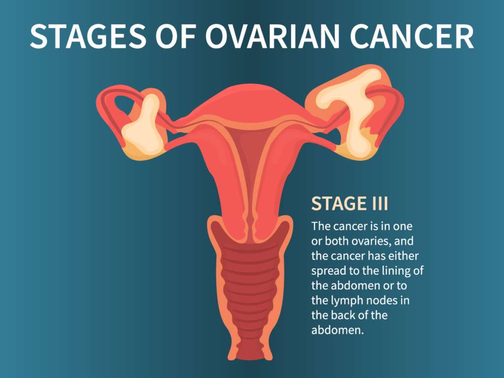 Understanding the 4 Stages of Ovarian Cancer Today