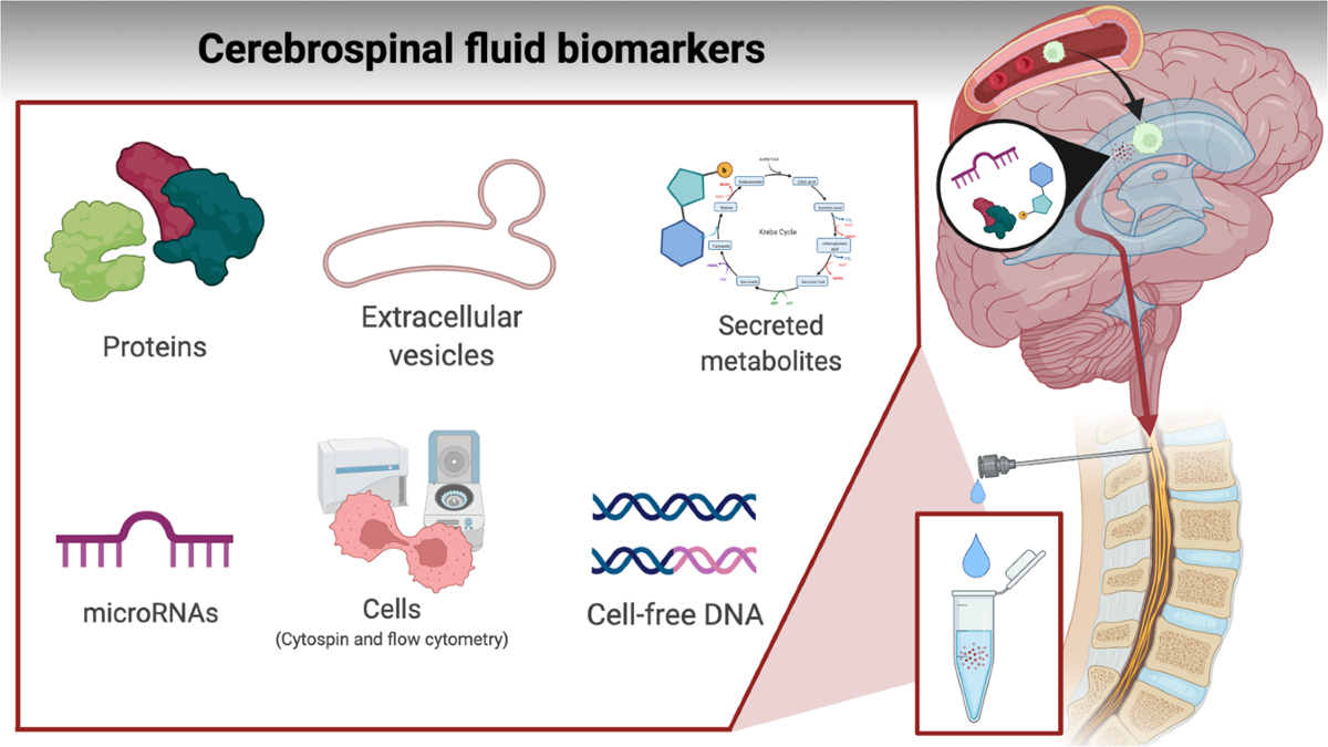 b-cell ALL CNS involvement: what you need to know