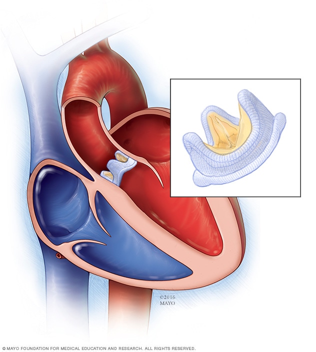 Biological Valve Replacement: Essential Facts