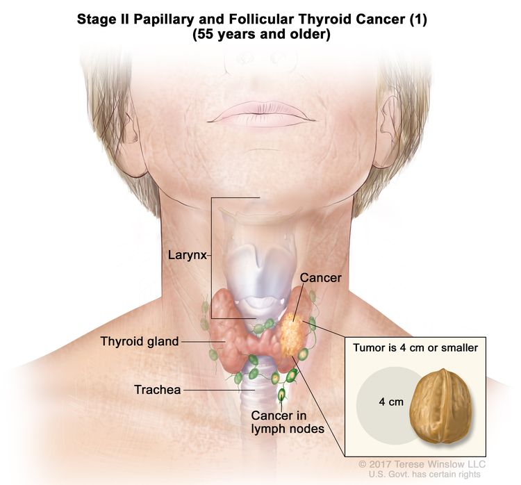 Can You Have Thyroid Cancer Without Nodules? Explained