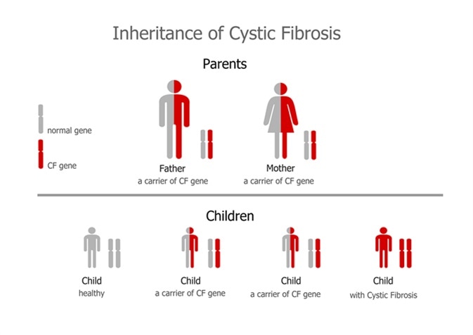 Does cystic fibrosis cause infertility in females?