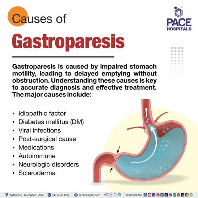 Gastroparesis Causes: What Really Triggers It