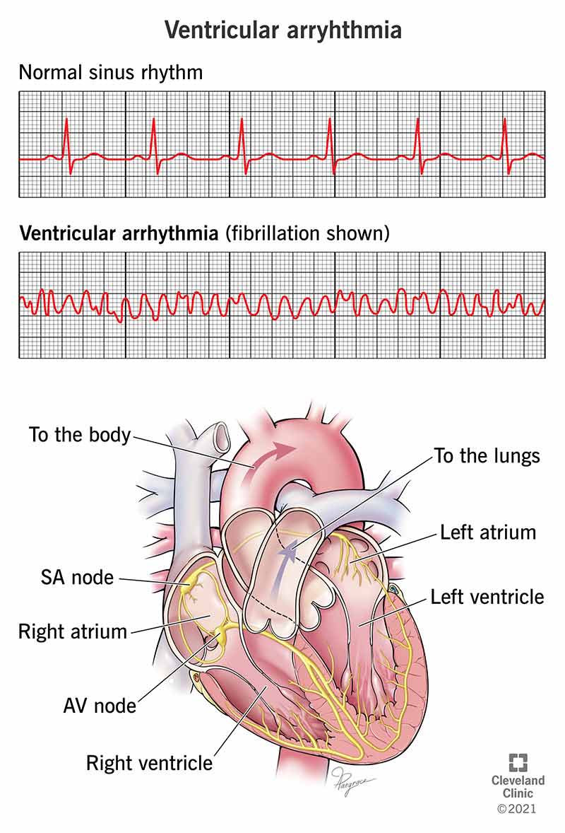 How I Cured My Arrhythmia Naturally – My Real Journey