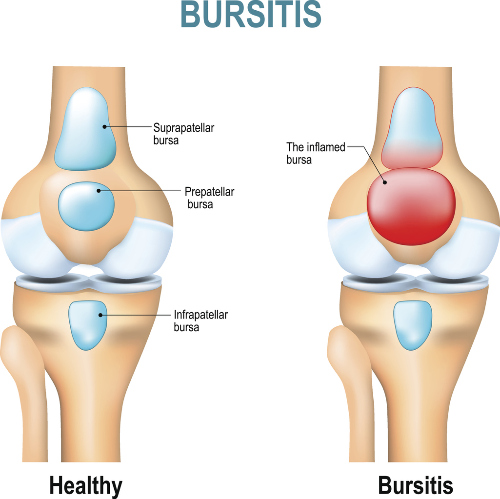 How I Cured My Bursitis – Simple Steps That Really Work