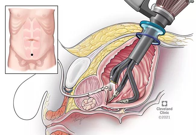 How Long Does a Robotic Simple Prostatectomy Take?