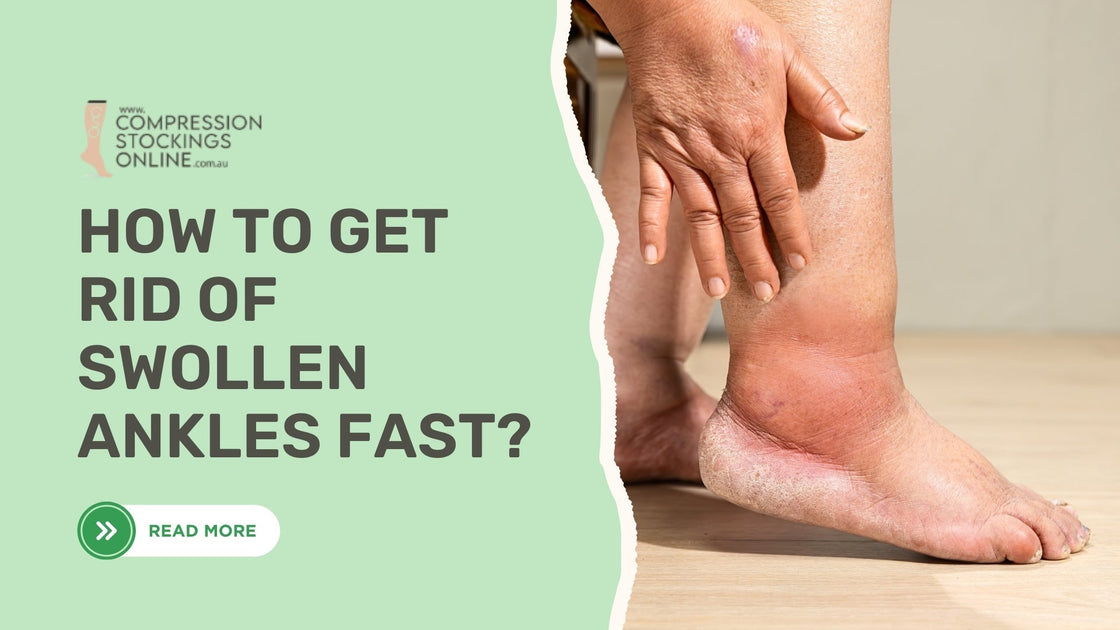 How to Get Rid of Swollen Ankles Fast – Quick Tips