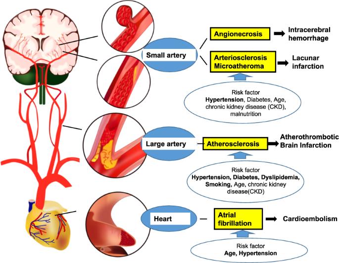Hypertension and Stroke Pathophysiology Explained Simply