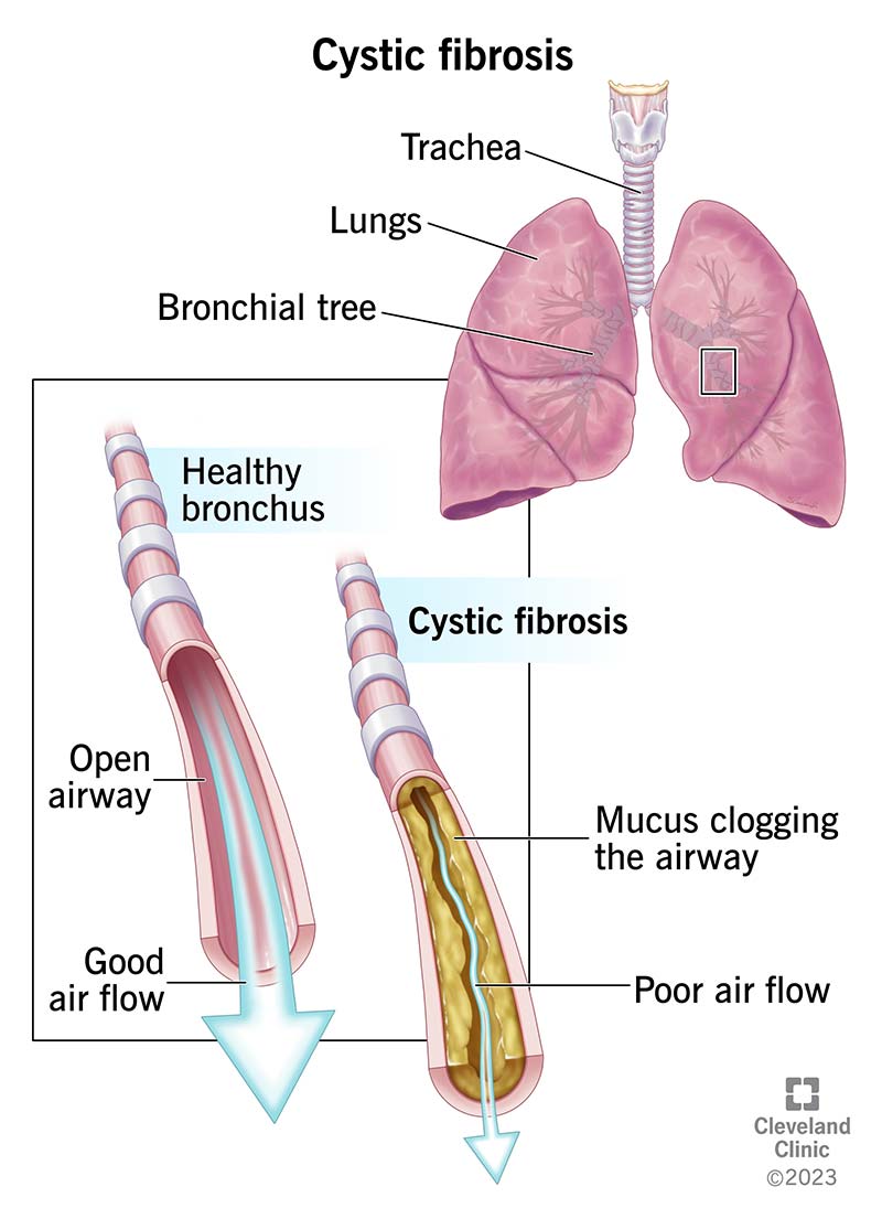 Is cystic fibrosis fatal? Life expectancy & hope