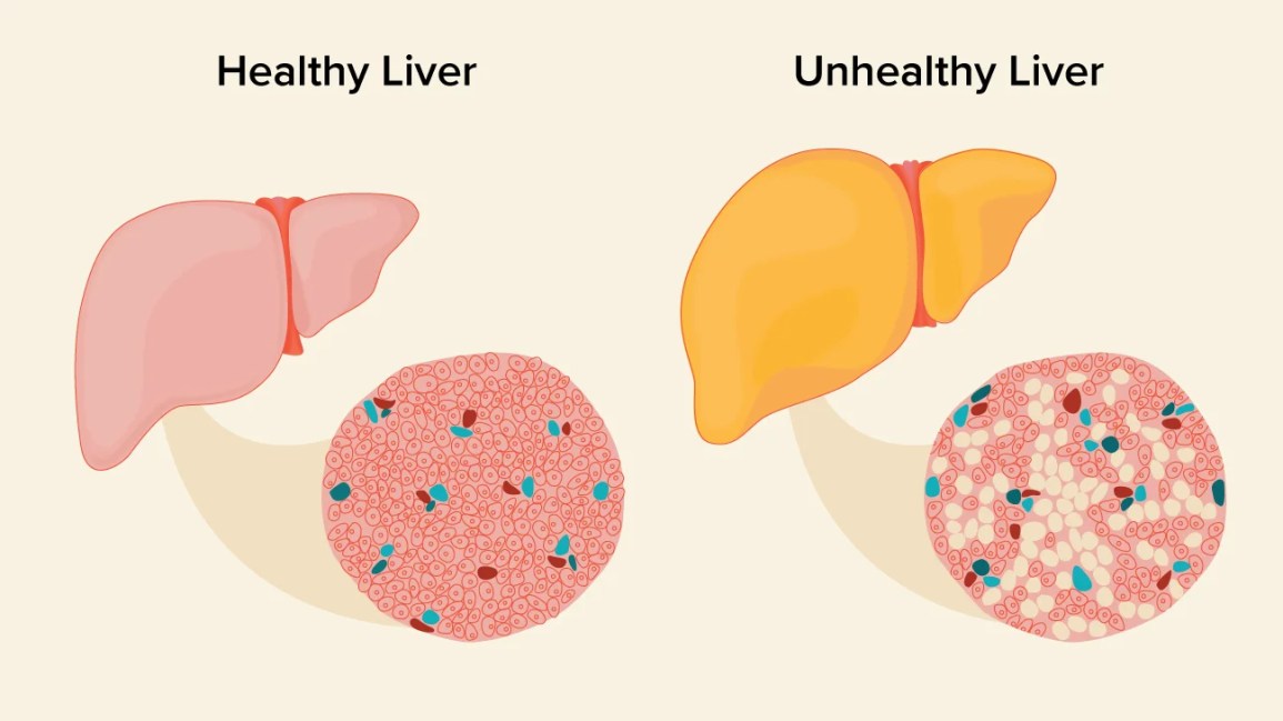 Is Fatty Liver Reversible With Weight Loss? See How
