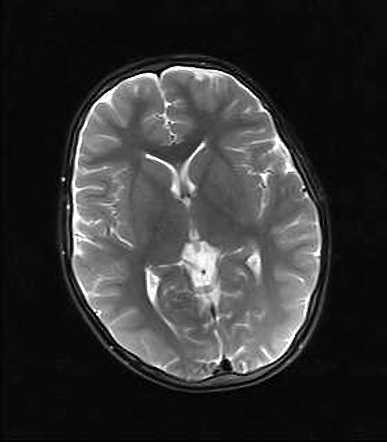 Leukemic Infiltration Brain Radiology: What to Know