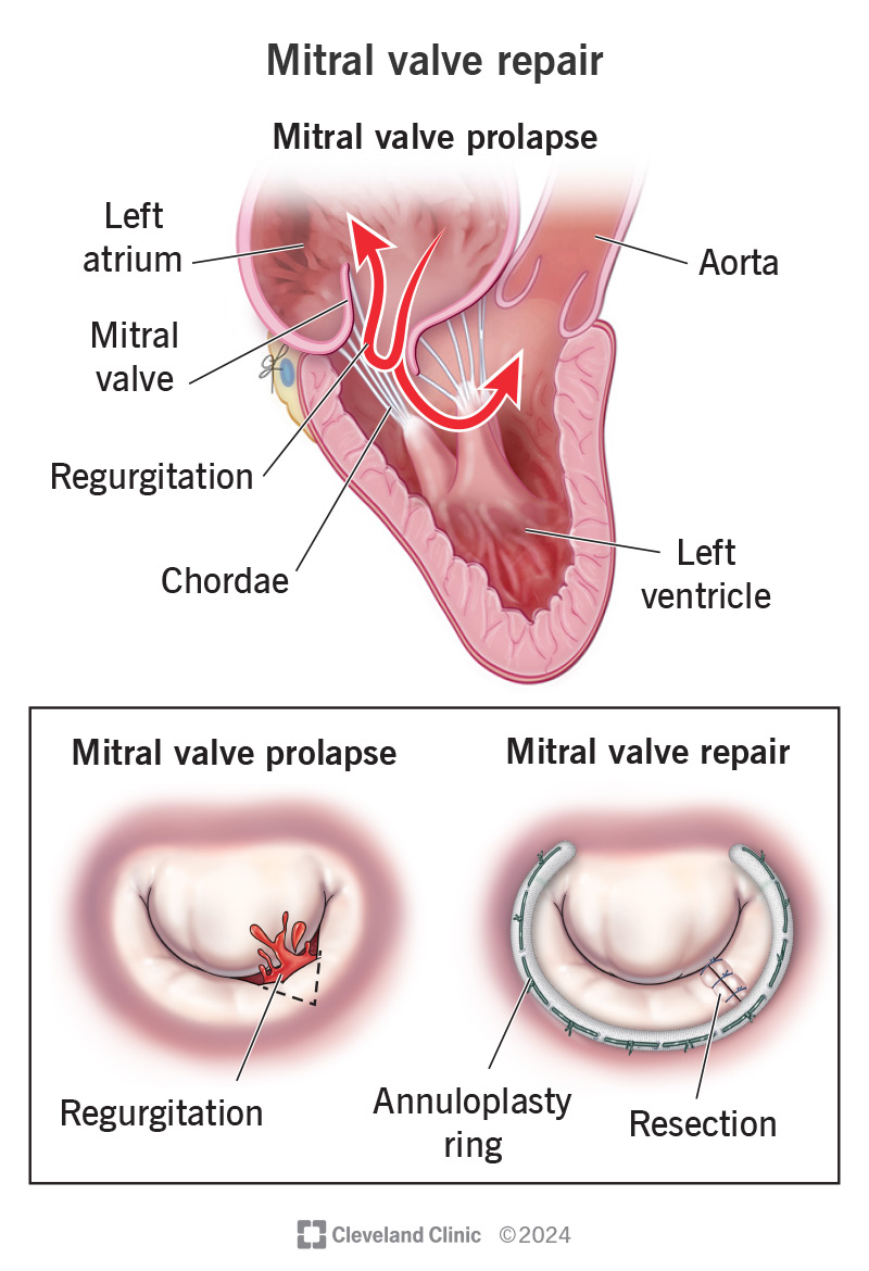 Mitral valve regurgitation treatment: options & risks