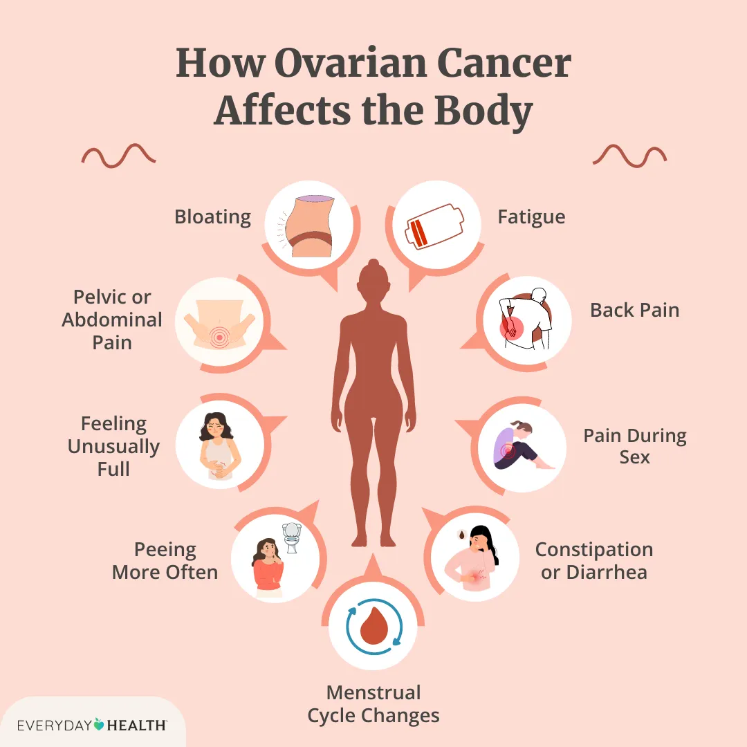 Ovarian Cancer Symptoms – What to Look For and How to Act