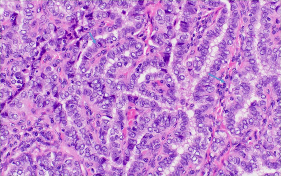 Papillary Thyroid Cancer Pathology Outlines Explained