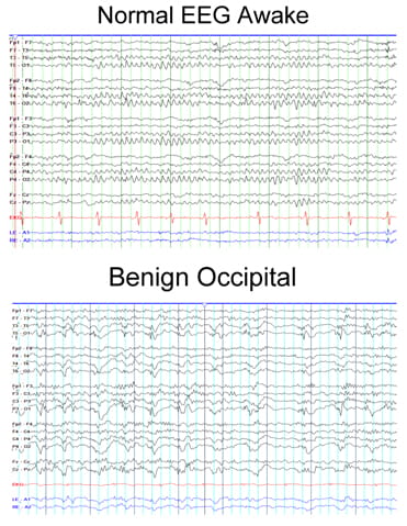 Seizures with Normal EEG and MRI: What It Means & What to Do