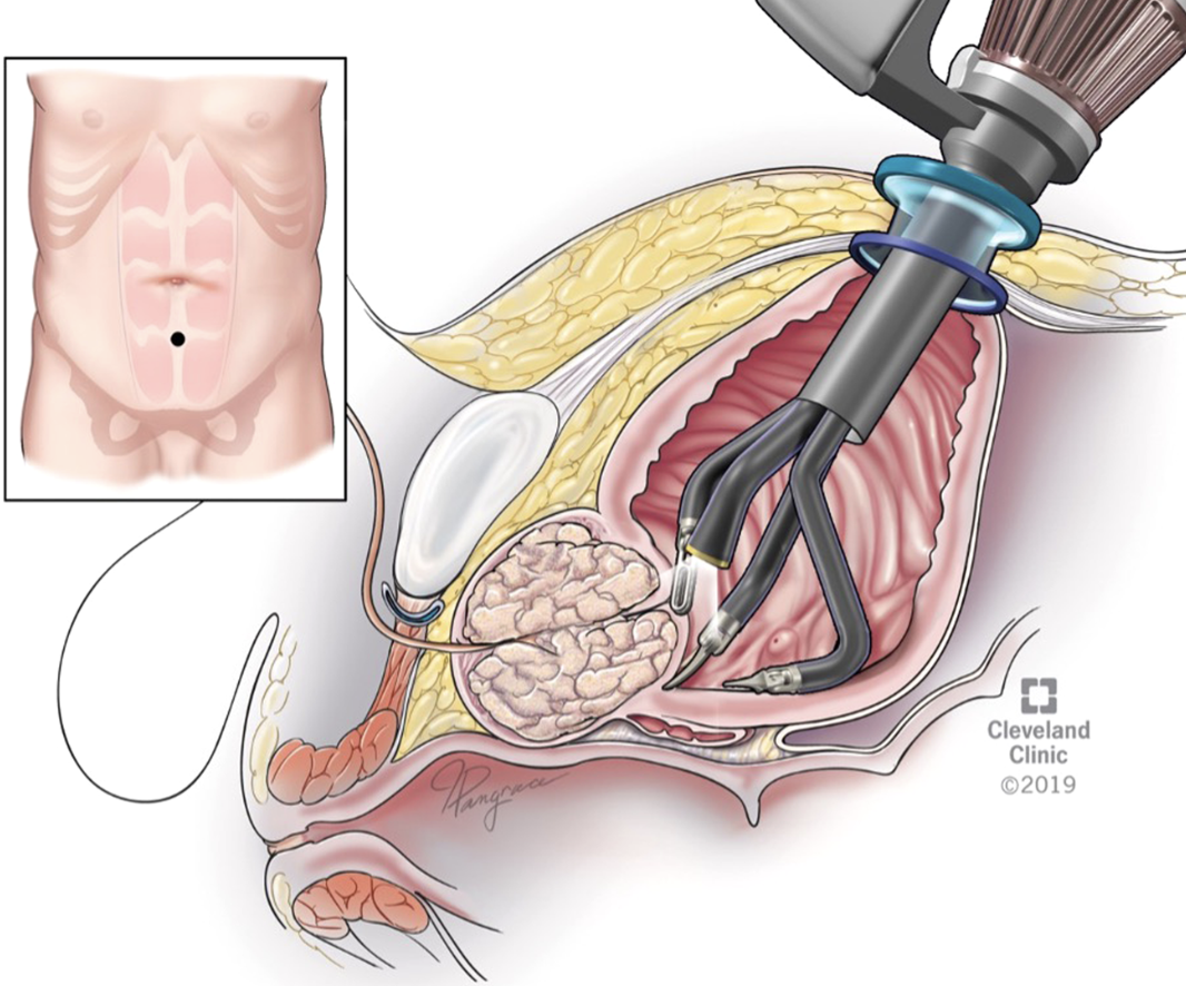 Simple Prostatectomy & ED: What You Must Know Today