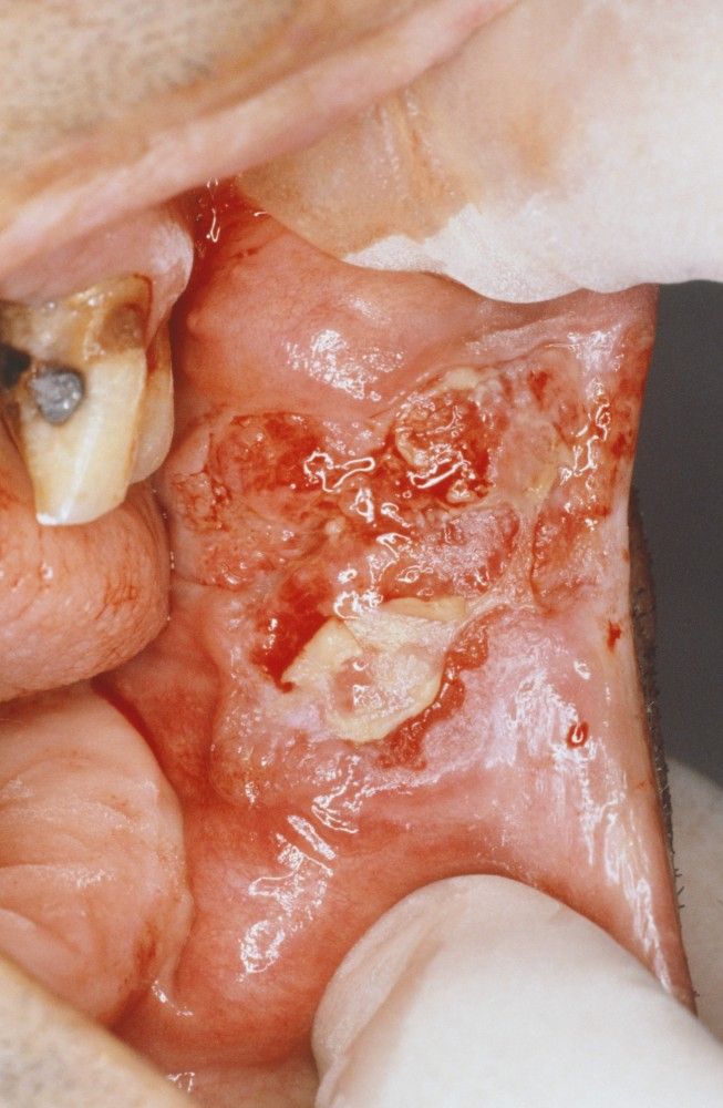 Squamous Cell Carcinoma Oral Cancer: Key Facts Survival