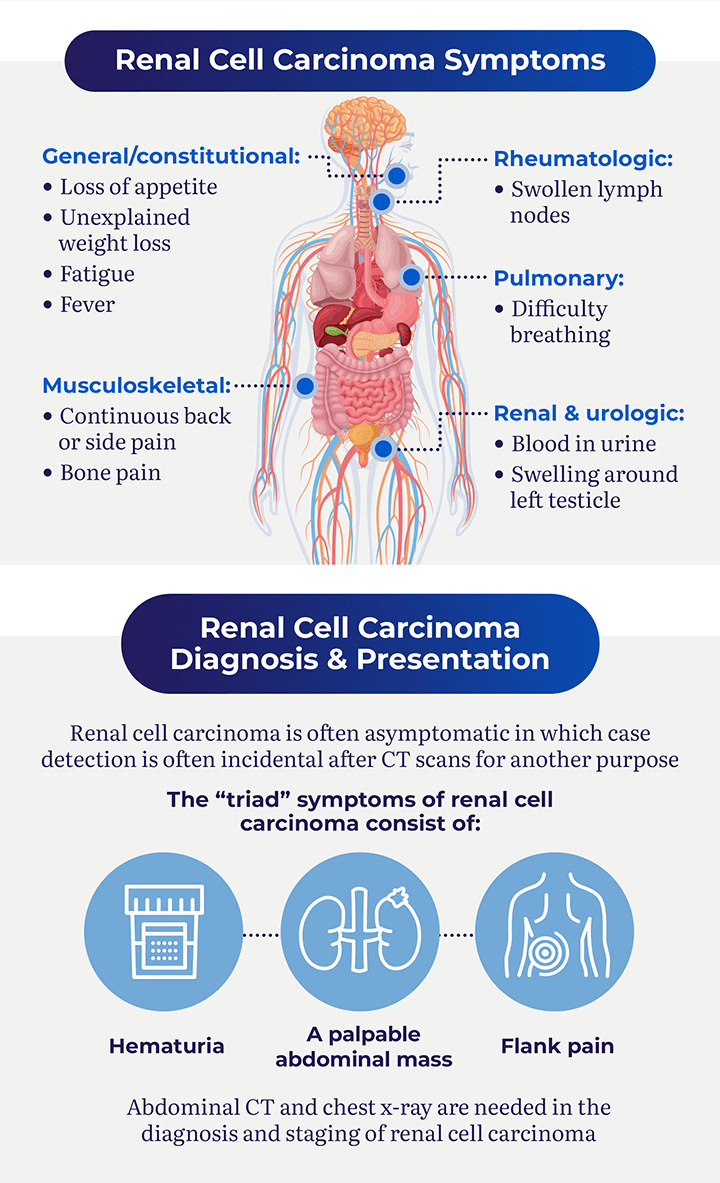 Stage 4 Kidney Cancer Symptoms & Life Expectancy