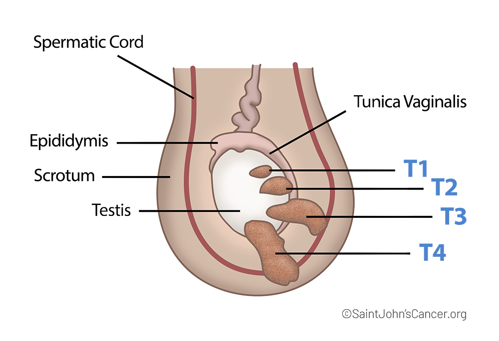 Where to Feel a Testicular Cancer Lump – Location Guide