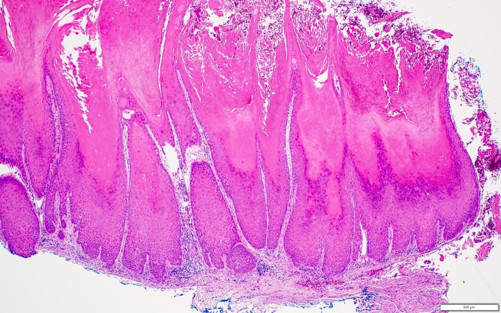 Verrucous carcinoma pathology outlines for clinicians
