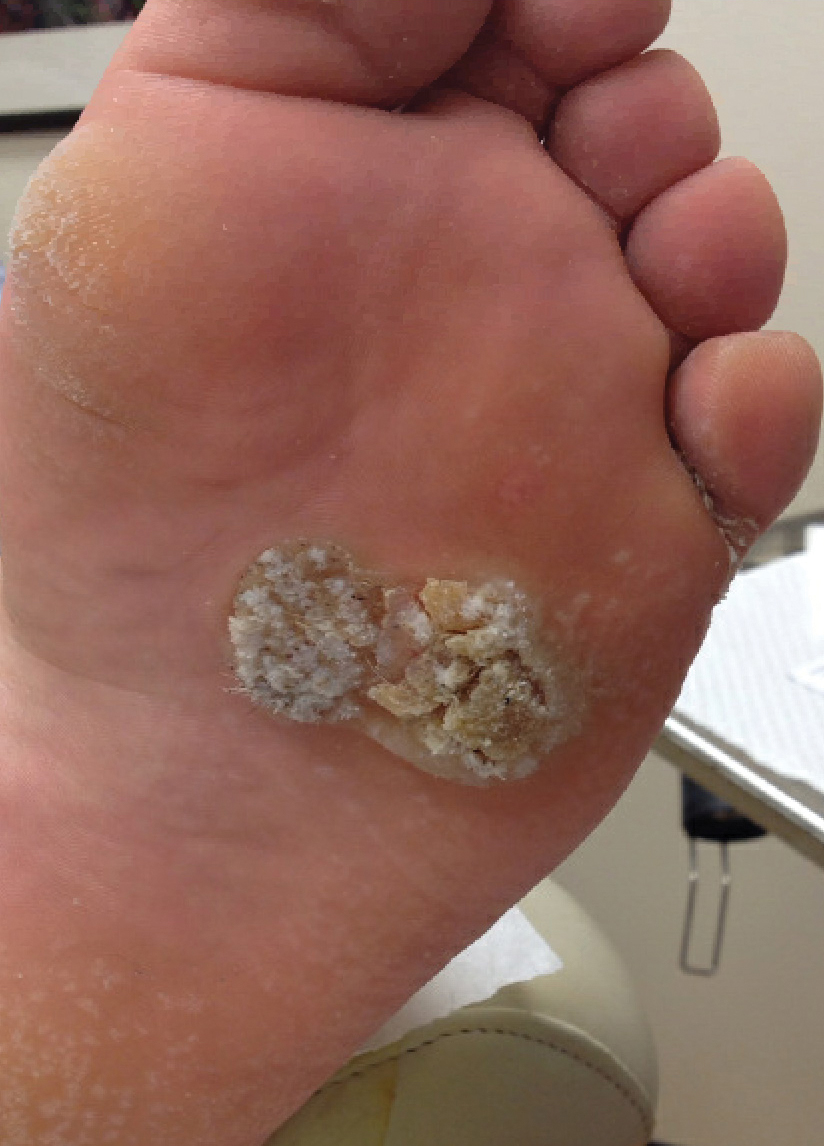 Verrucous Carcinoma Pictures: What They Really Show