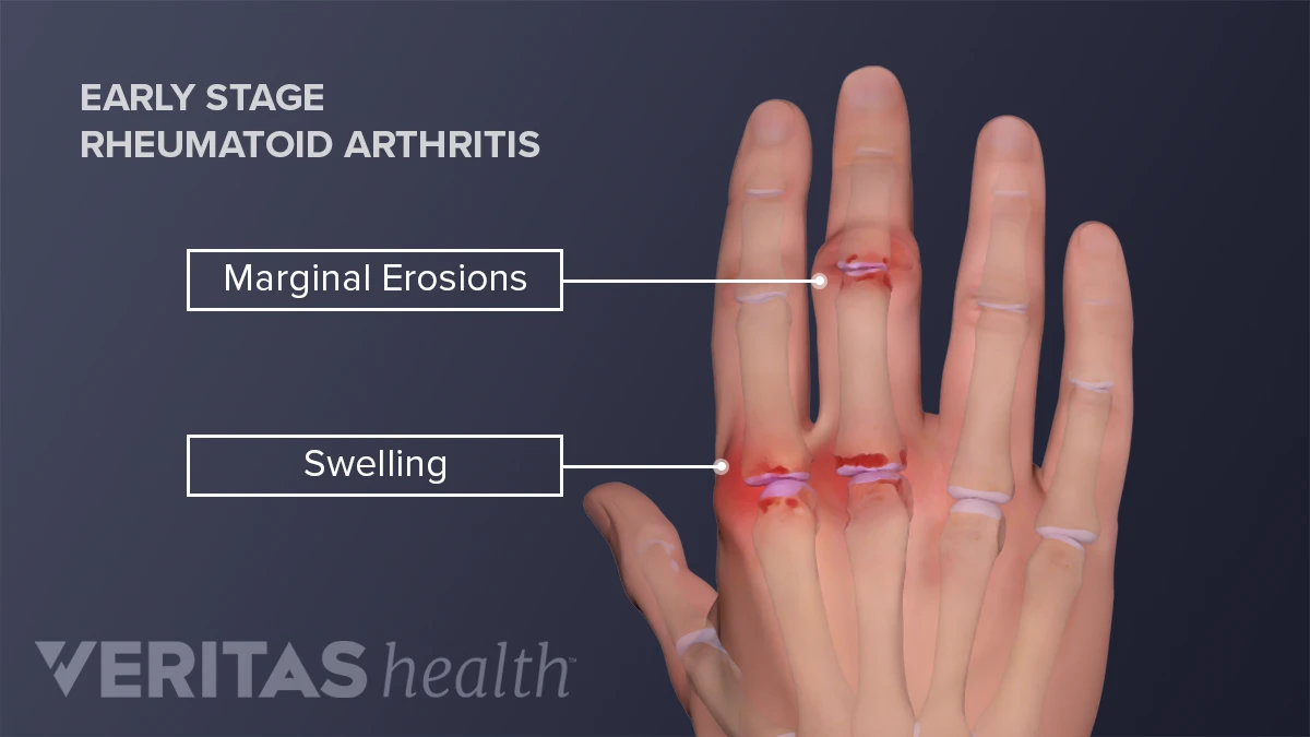 What Are the First Signs of Arthritis in Fingers?