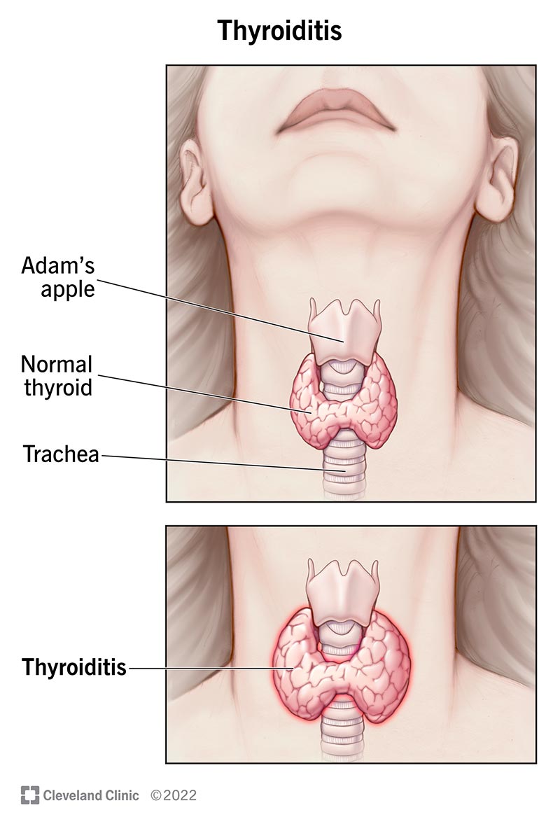 What Does Thyroid Pain Feel Like? Symptoms & Relief