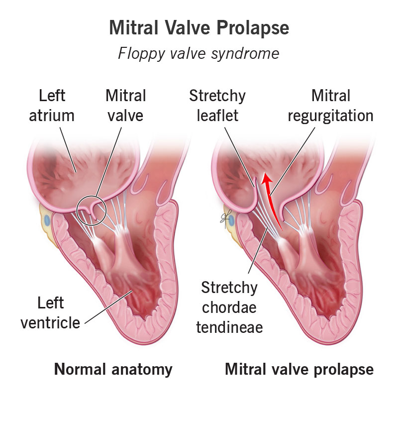 aml medical abbreviation cardiology: What It Means