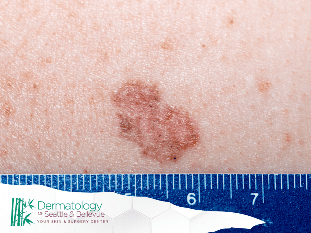 Basal Cell Carcinoma: Spot It Early, Treat It Right
